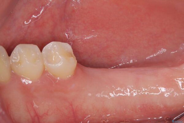挺出歯を圧下してスペースを確保!目立たない部分矯正で下顎大臼歯にインプラント治療を実現 治療前画像