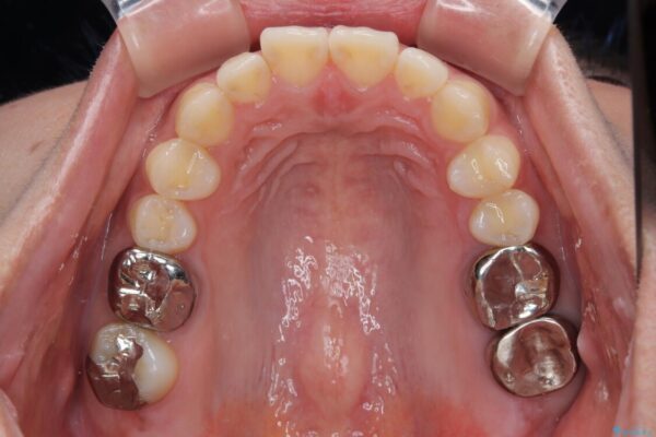 挺出歯を圧下してスペースを確保!目立たない部分矯正で下顎大臼歯にインプラント治療を実現 治療前画像