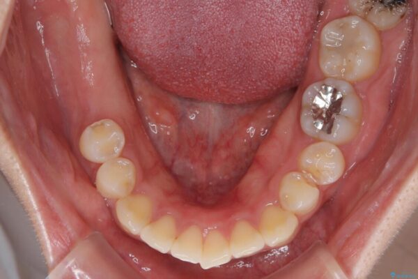 挺出歯を圧下してスペースを確保!目立たない部分矯正で下顎大臼歯にインプラント治療を実現 治療前画像