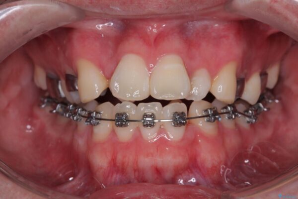 1年でここまで変わる!歯列のがたつきと正中のズレを改善した矯正治療(メタルブラケット×MARPE) 治療途中画像