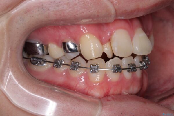 1年でここまで変わる!歯列のがたつきと正中のズレを改善した矯正治療(メタルブラケット×MARPE) 治療途中画像