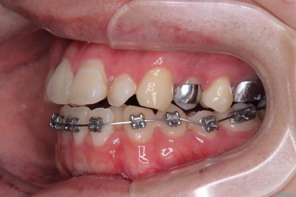 1年でここまで変わる!歯列のがたつきと正中のズレを改善した矯正治療(メタルブラケット×MARPE) 治療途中画像