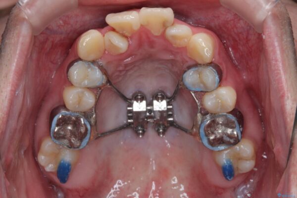 1年でここまで変わる!歯列のがたつきと正中のズレを改善した矯正治療(メタルブラケット×MARPE) 治療途中画像
