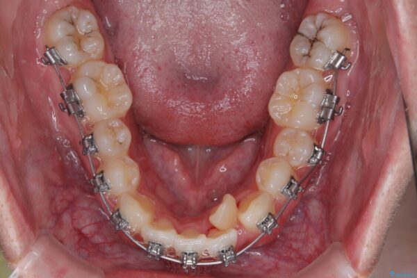 1年でここまで変わる!歯列のがたつきと正中のズレを改善した矯正治療(メタルブラケット×MARPE) 治療途中画像
