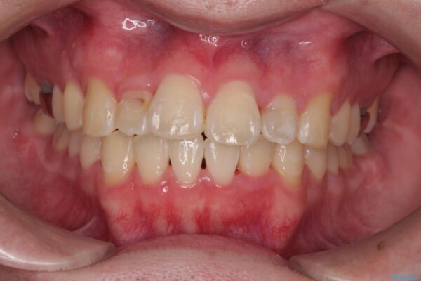 1年でここまで変わる!歯列のがたつきと正中のズレを改善した矯正治療(メタルブラケット×MARPE) 治療後画像