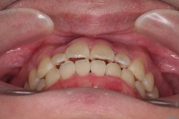 1年でここまで変わる!歯列のがたつきと正中のズレを改善した矯正治療(メタルブラケット×MARPE) 治療後画像