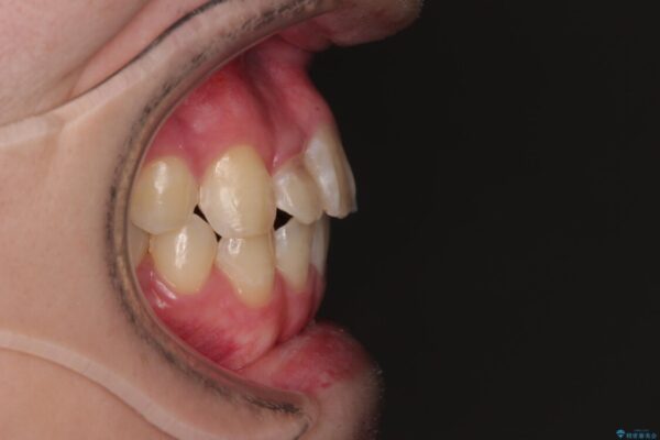 1年でここまで変わる!歯列のがたつきと正中のズレを改善した矯正治療(メタルブラケット×MARPE) 治療後画像