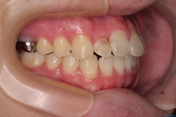 1年でここまで変わる!歯列のがたつきと正中のズレを改善した矯正治療(メタルブラケット×MARPE) 治療後画像