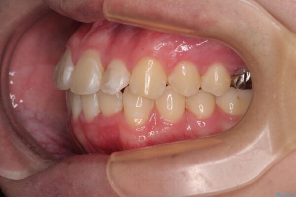 1年でここまで変わる!歯列のがたつきと正中のズレを改善した矯正治療(メタルブラケット×MARPE) 治療後画像
