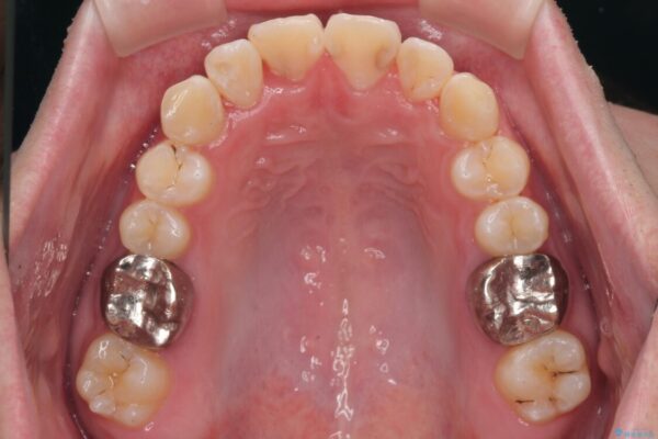 1年でここまで変わる!歯列のがたつきと正中のズレを改善した矯正治療(メタルブラケット×MARPE) 治療後画像