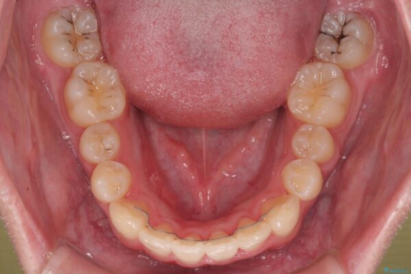 1年でここまで変わる!歯列のがたつきと正中のズレを改善した矯正治療(メタルブラケット×MARPE) 治療後画像