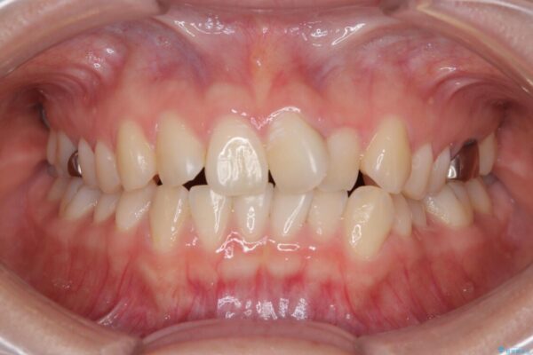 前歯のねじれ・ガタガタを10か月で改善!20代女性の矯正治療|クリアブラケットでむし歯になりにくい歯並びへ改善 ビフォー