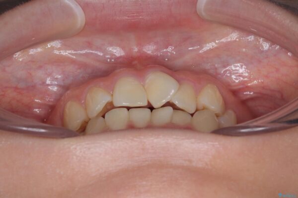 前歯のねじれ・ガタガタを10か月で改善!20代女性の矯正治療|クリアブラケットでむし歯になりにくい歯並びへ改善 治療前画像