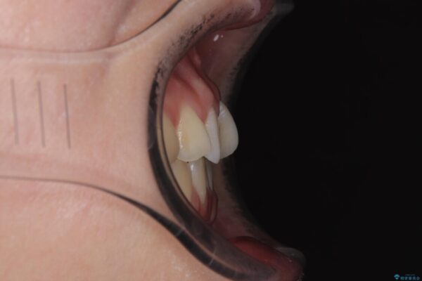 前歯のねじれ・ガタガタを10か月で改善!20代女性の矯正治療|クリアブラケットでむし歯になりにくい歯並びへ改善 治療前画像