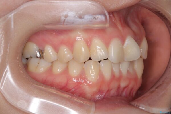 前歯のねじれ・ガタガタを10か月で改善!20代女性の矯正治療|クリアブラケットでむし歯になりにくい歯並びへ改善 治療前画像