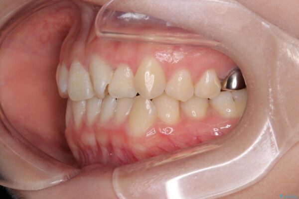 前歯のねじれ・ガタガタを10か月で改善!20代女性の矯正治療|クリアブラケットでむし歯になりにくい歯並びへ改善 治療前画像