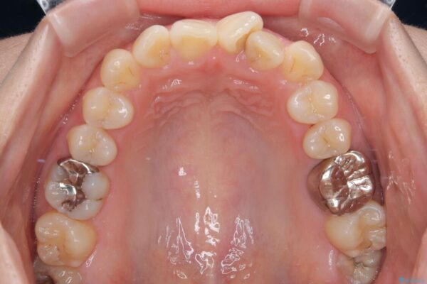 前歯のねじれ・ガタガタを10か月で改善!20代女性の矯正治療|クリアブラケットでむし歯になりにくい歯並びへ改善 治療前画像