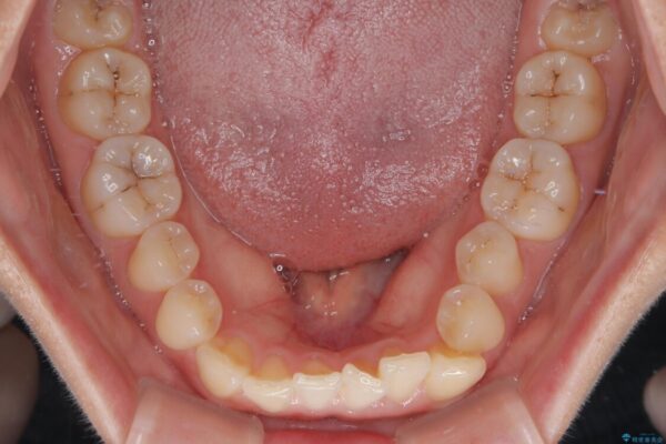 前歯のねじれ・ガタガタを10か月で改善!20代女性の矯正治療|クリアブラケットでむし歯になりにくい歯並びへ改善 治療前画像