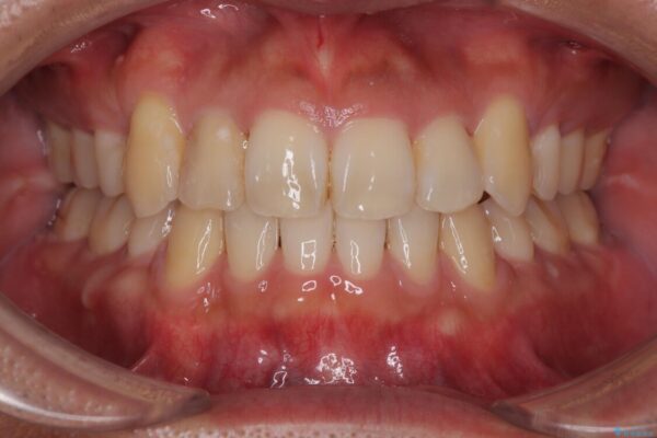 八重歯と前歯のガタガタを抜歯矯正で治療|クリアブラケット使用例 アフター