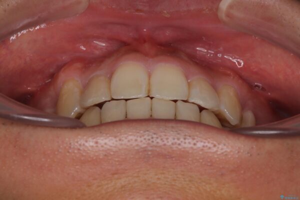 八重歯と前歯のガタガタを抜歯矯正で治療|クリアブラケット使用例 治療後画像