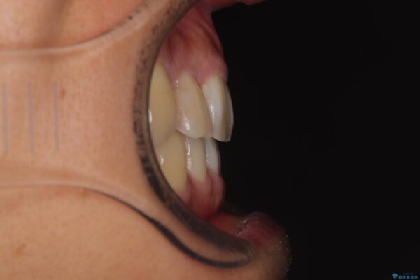 八重歯と前歯のガタガタを抜歯矯正で治療|クリアブラケット使用例 治療後画像