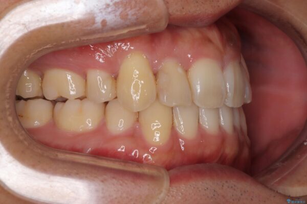 八重歯と前歯のガタガタを抜歯矯正で治療|クリアブラケット使用例 治療後画像
