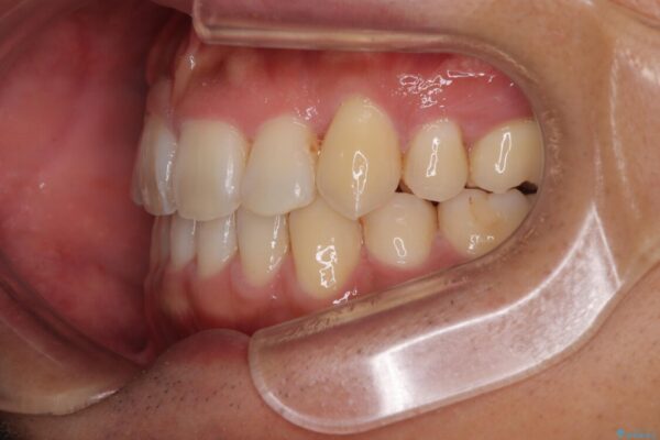 八重歯と前歯のガタガタを抜歯矯正で治療|クリアブラケット使用例 治療後画像