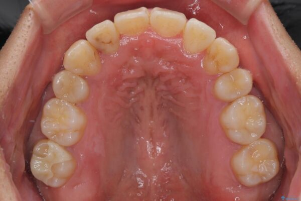 八重歯と前歯のガタガタを抜歯矯正で治療|クリアブラケット使用例 治療後画像