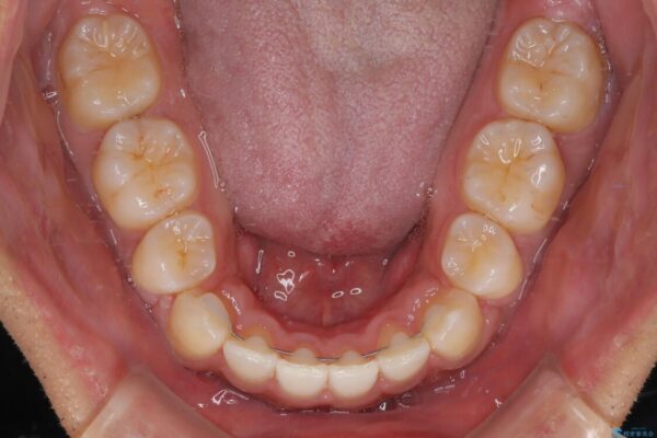 八重歯と前歯のガタガタを抜歯矯正で治療|クリアブラケット使用例 治療後画像