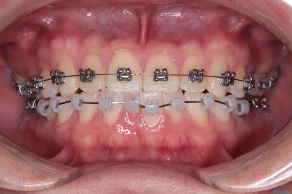 前歯のガタガタ・奥歯のかみ合わせ(シザーズバイト)を改善|1年半で完了したメタルブラケット矯正 治療途中画像