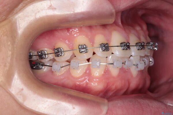 前歯のガタガタ・奥歯のかみ合わせ(シザーズバイト)を改善|1年半で完了したメタルブラケット矯正 治療途中画像
