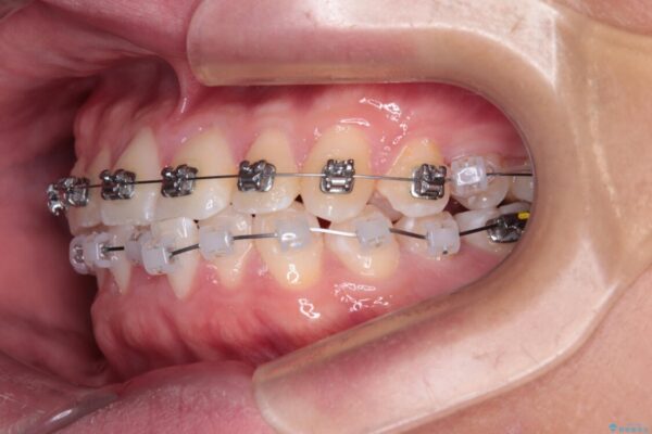 前歯のガタガタ・奥歯のかみ合わせ(シザーズバイト)を改善|1年半で完了したメタルブラケット矯正 治療途中画像