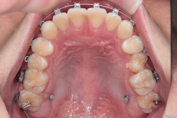 前歯のガタガタ・奥歯のかみ合わせ(シザーズバイト)を改善|1年半で完了したメタルブラケット矯正 治療途中画像