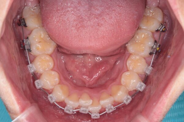 前歯のガタガタ・奥歯のかみ合わせ(シザーズバイト)を改善|1年半で完了したメタルブラケット矯正 治療途中画像