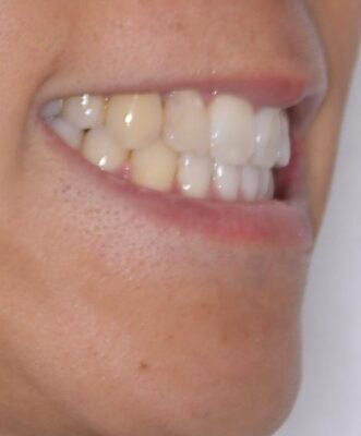 八重歯と前歯のガタガタを抜歯矯正で治療|クリアブラケット使用例 治療後画像
