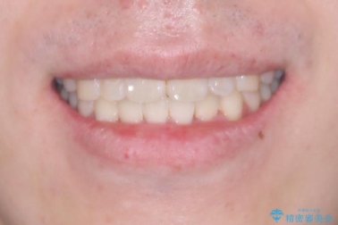 1年でここまで変わる!歯列のがたつきと正中のズレを改善した矯正治療(メタルブラケット×MARPE) アフター