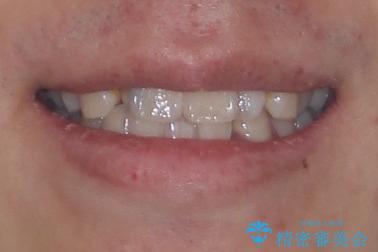 1年でここまで変わる!歯列のがたつきと正中のズレを改善した矯正治療(メタルブラケット×MARPE) ビフォー