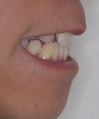 八重歯と前歯のガタガタを抜歯矯正で治療|クリアブラケット使用例 治療前画像