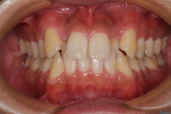 八重歯と前歯のガタガタを抜歯矯正で治療|クリアブラケット使用例 ビフォー