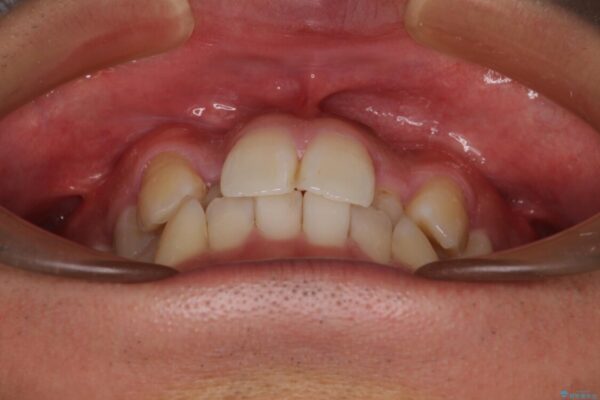 八重歯と前歯のガタガタを抜歯矯正で治療|クリアブラケット使用例 治療前画像