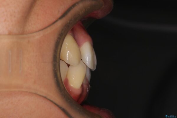 八重歯と前歯のガタガタを抜歯矯正で治療|クリアブラケット使用例 治療前画像