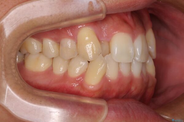 八重歯と前歯のガタガタを抜歯矯正で治療|クリアブラケット使用例 治療前画像