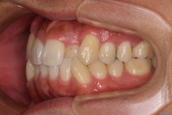 八重歯と前歯のガタガタを抜歯矯正で治療|クリアブラケット使用例 治療前画像