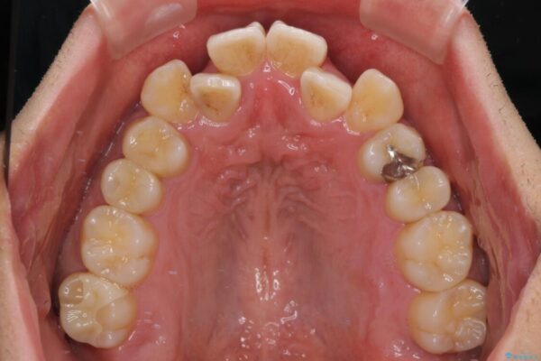 八重歯と前歯のガタガタを抜歯矯正で治療|クリアブラケット使用例 治療前画像