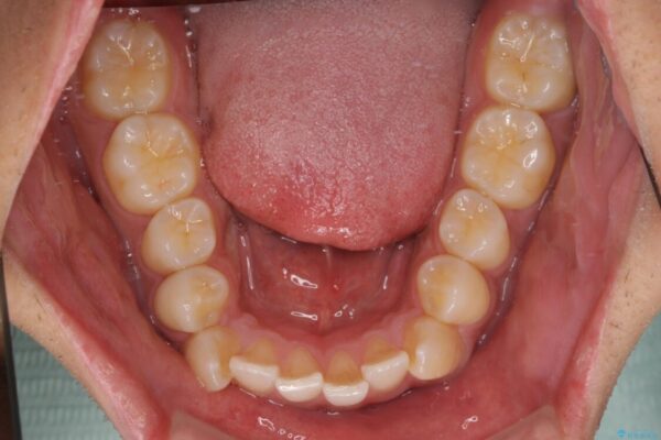 八重歯と前歯のガタガタを抜歯矯正で治療|クリアブラケット使用例 治療前画像