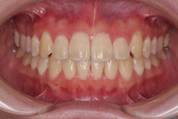 【モニター】前歯のデコボコをスッキリ解消!目立ちにくいワイヤー矯正でスピーディに治療完了 アフター