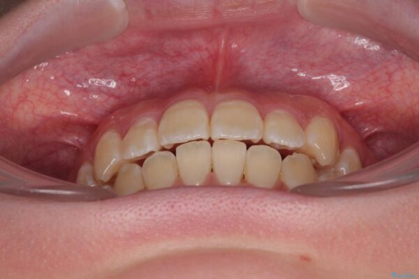 【モニター】前歯のデコボコをスッキリ解消!目立ちにくいワイヤー矯正でスピーディに治療完了 治療後画像