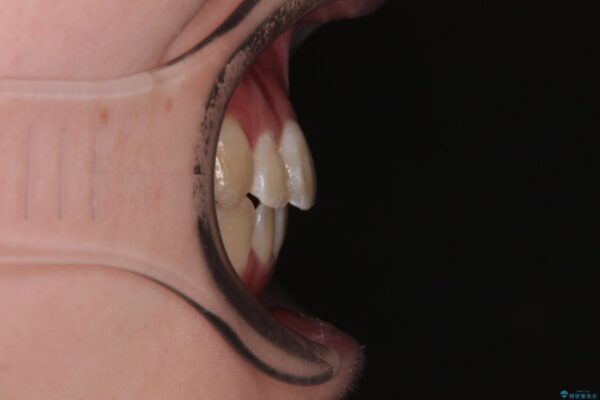 【モニター】前歯のデコボコをスッキリ解消!目立ちにくいワイヤー矯正でスピーディに治療完了 治療後画像