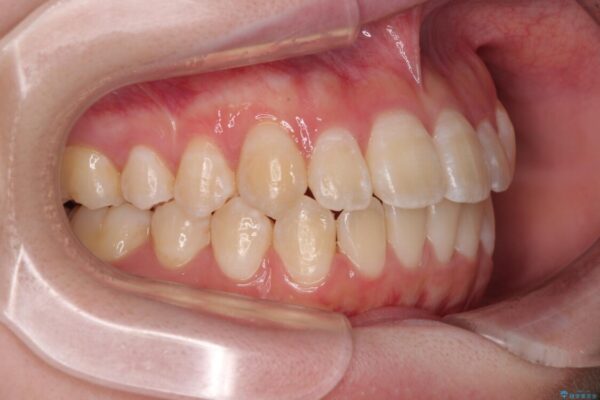 【モニター】前歯のデコボコをスッキリ解消!目立ちにくいワイヤー矯正でスピーディに治療完了 治療後画像