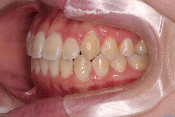 【モニター】前歯のデコボコをスッキリ解消!目立ちにくいワイヤー矯正でスピーディに治療完了 治療後画像